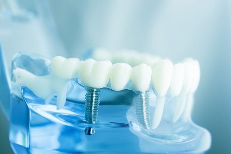 implantologia quanto dura impianto dentale, dentiera a Rivoli